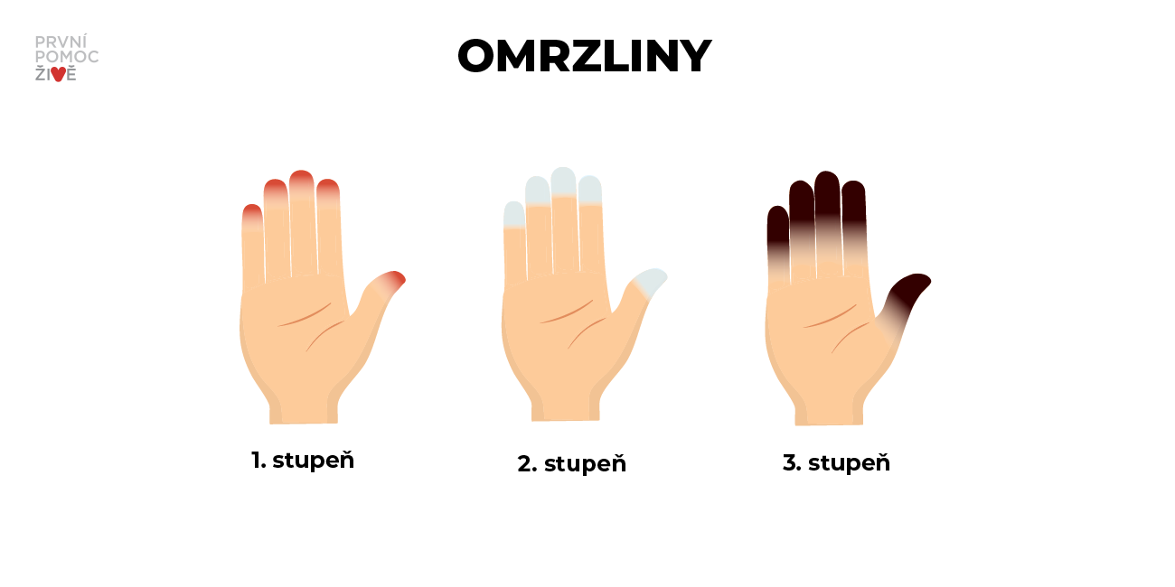 Omrzliny 1. stupně - kůže je bledá, může mít i nafialovělý nádech.Omrzliny 2. stupně - kůže získává bílý až žlutý odstín. Mohou se tvořit i puchýře. Omrzliny 3. stupně - kůže je tmavá, tvrdá a vosková.